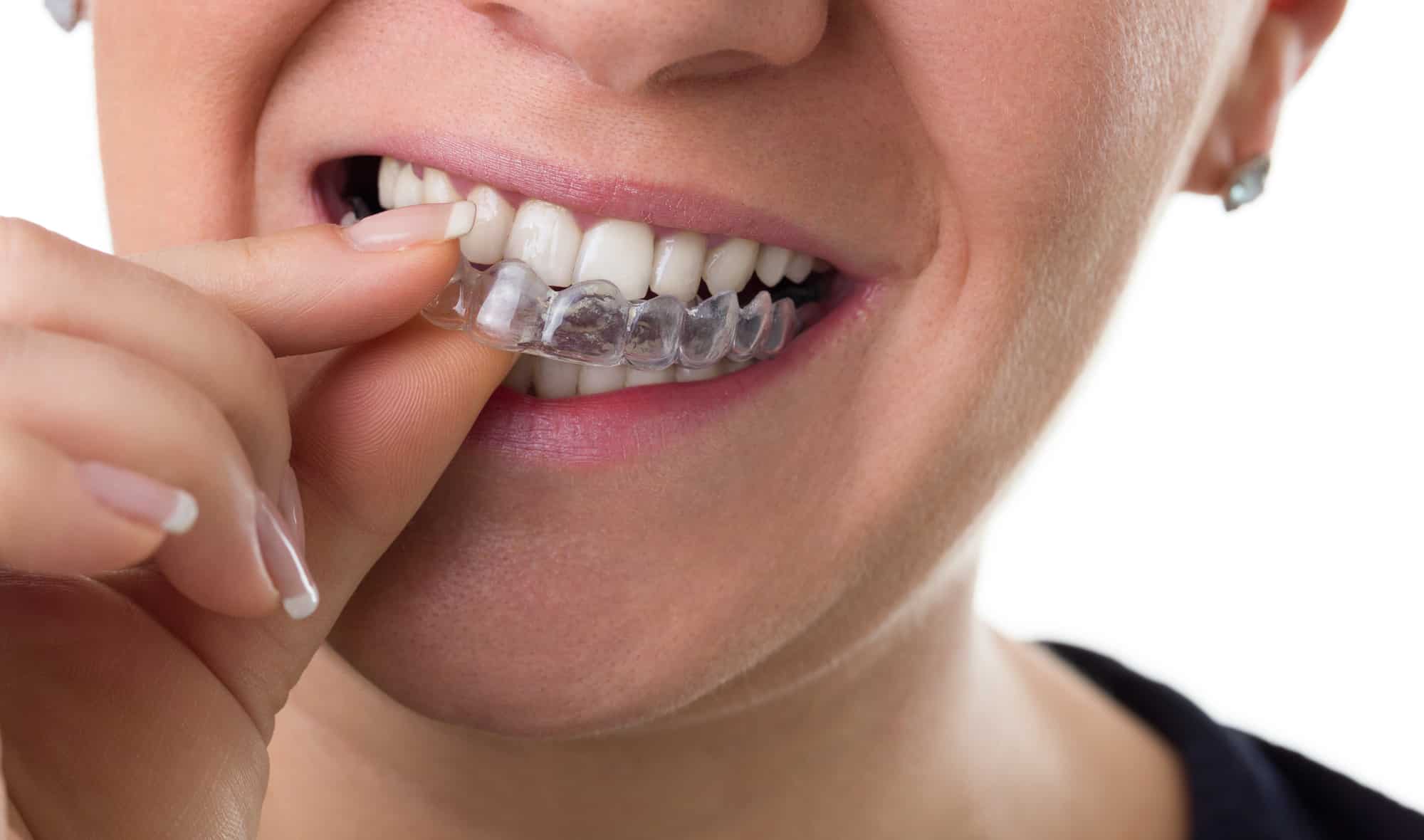 How Much are Dental Retainers in the UK? Cost & How to Save Brit Buyer
