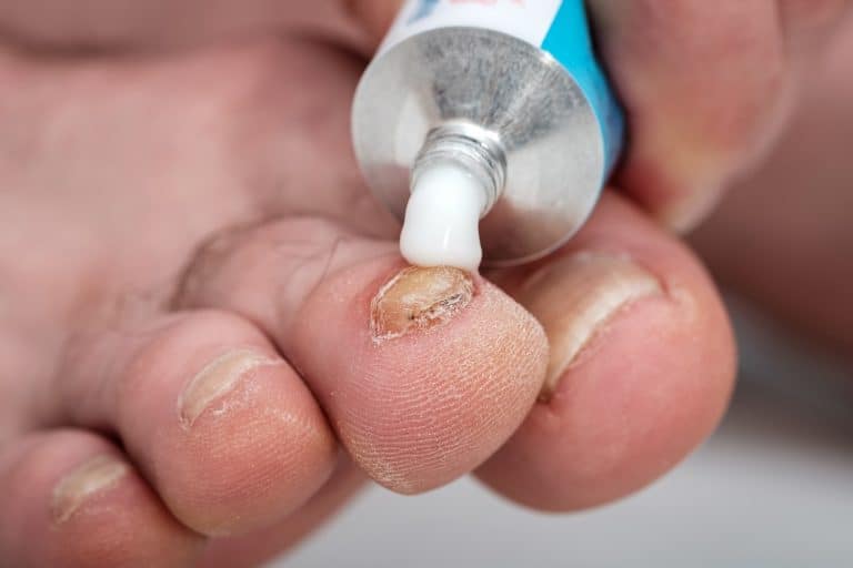 The 5 Best Nail Fungus Treatments in the UK Brit Buyer