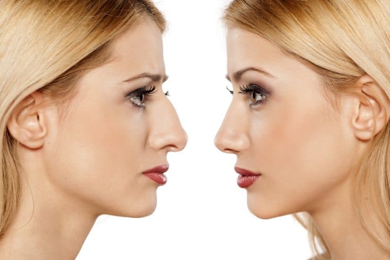 How Much is a Nose Job (Rhinoplasty) in the UK? Average Costs Brit Buyer